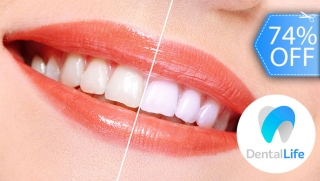 Blanqueamiento con Luz LED + Limpieza Dental y Más