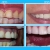 [Image: ¡Paga $25 en lugar de $75 por Reconstrucción De Dientes Frontales que Incluye: 2 Carillas Dentales de Resina Nano Híbrida de Porcelana y Zirconio + Limpieza Dental con Ultrasonido + Aplicación de Flúor!m]