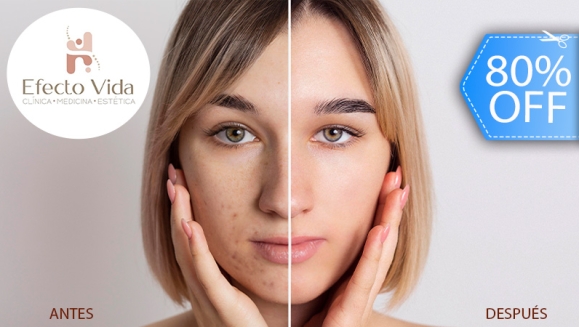 [Image: ¡Paga Q75 en Lugar de Q380 por 1 Sesión de Láser IPL para Manchas con: Peeling Químico + IPL + Mascarilla + Cabina LED + Aplicación de Vitamina C + Aplicación de Retinol + Aplicación de Crema para Manchas y Protector Solar!m]