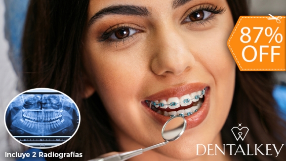 [Image: ¡Paga $35 en Lugar de $273 por Colocación de Brackets Metálicos (Superiores e Inferiores) + Evaluación  General y Especializada para Ortodoncia + Limpieza Dental +  2 Radiografías (Panorámica y Cefalométrica) + Análisis Cefalométrico!m]