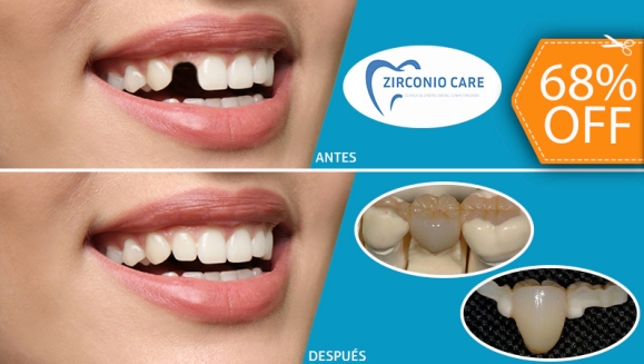 [Image: ¡Paga $85 en Lugar de $265 por 1 Pieza Dental de Zirconio, Resina y Porcelana (Sin Metales) + Limpieza Dental con Ultrasonido + Evaluación de Cordales!m]