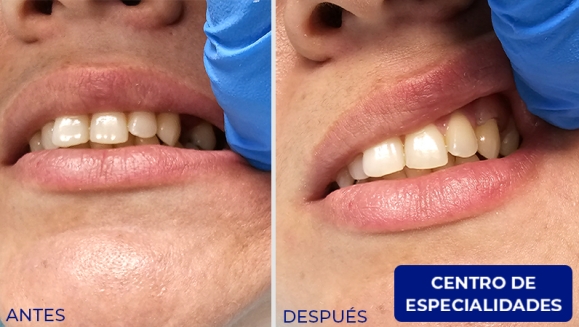 [Image: ¡Paga $250 en Lugar de $550 por Prótesis Dental Unilateral Removible (hasta 5 Dientes) + Diagnóstico y Evaluación con Cámara Intraoral + Limpieza con Ultrasonido + Pulido Dental + Aplicación de Flúor + 2 Sellantes + Evaluación de Cordales!m]